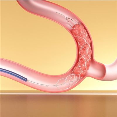 DSA-geleide Stent Retriever voor acuut herseninfarct